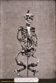 Angolkór miatt deformálódott csontváz (1879)