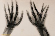Röntgenkép deformált ujjakról