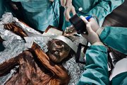 Idegsebészek végeznek boncolást 2011-ben Ötzin, az 5 ezer éves jégemberen