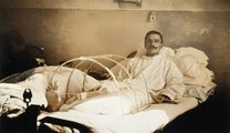 Amputált francia katona az első világháborúban