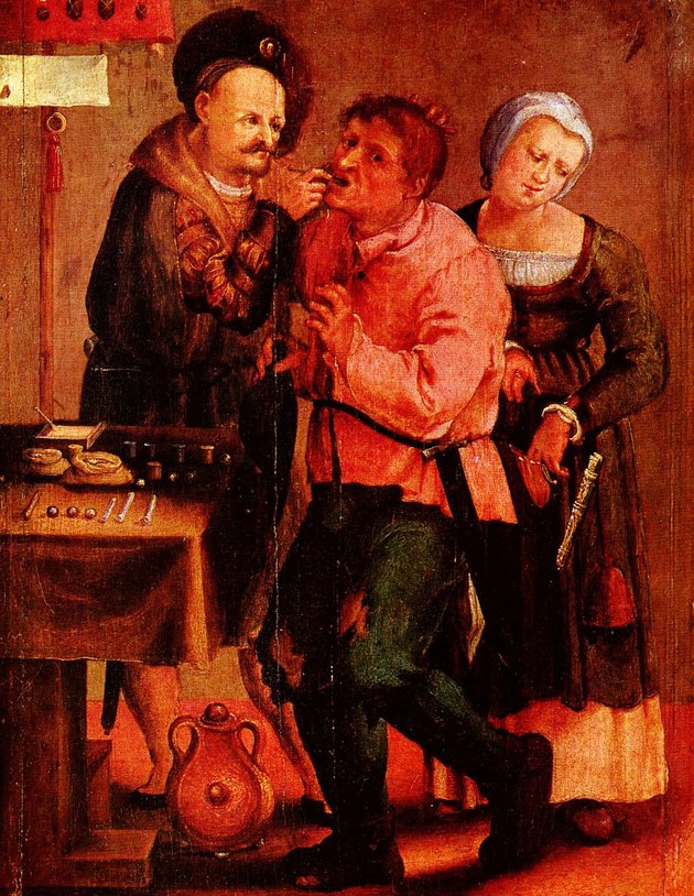 A 19. századig a foghúzás egy mindennapos, mégis igen fájdalmas művelet maradt (Johann Liss festménye a 17. századból)