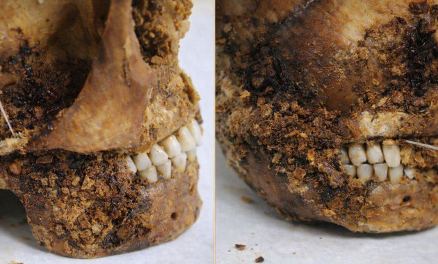 2500 éves műtét nyomát tárták fel a szkíták korából