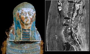 
	Először diagnosztizáltak prosztatarákot egy egyiptomi múmiánál
