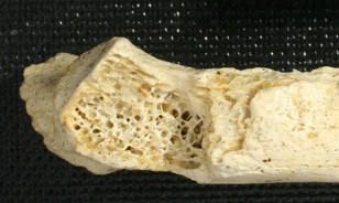 
	Csontrákot fedeztek fel a neandervölgyi ősembernél
