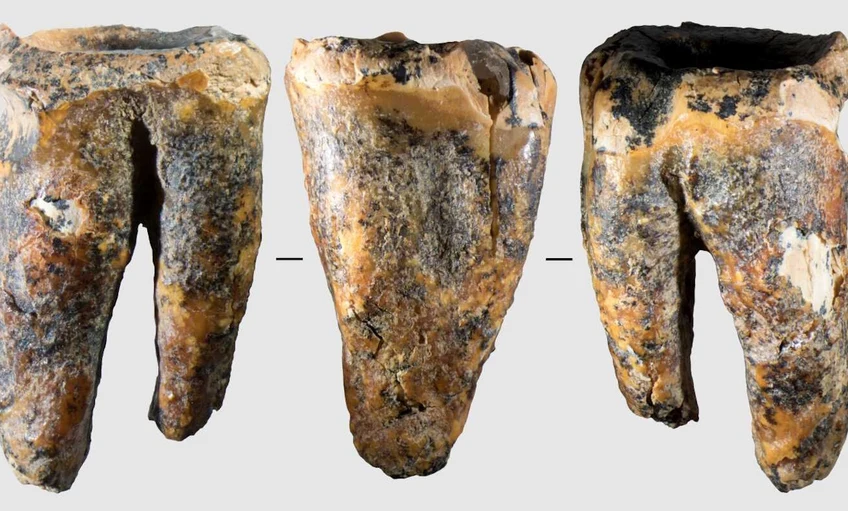 Már a neandervölgyi fogorvosok is használtak fúrót