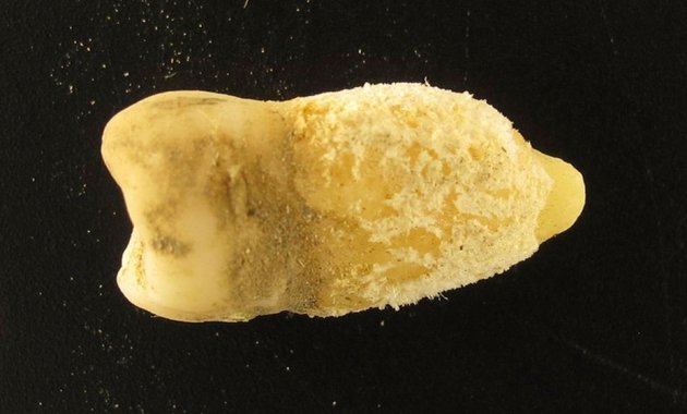 Skarlátot okozó baktériumot fedeztek fel egy középkori fogban