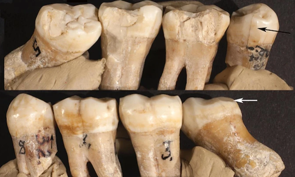 Neandervölgyi fogak