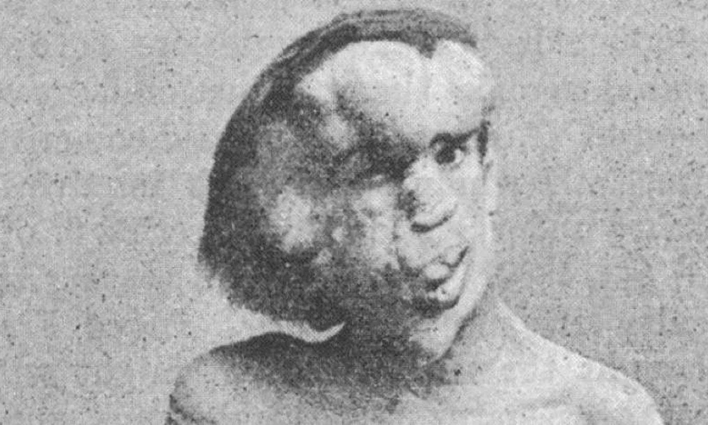 Joseph Merrick