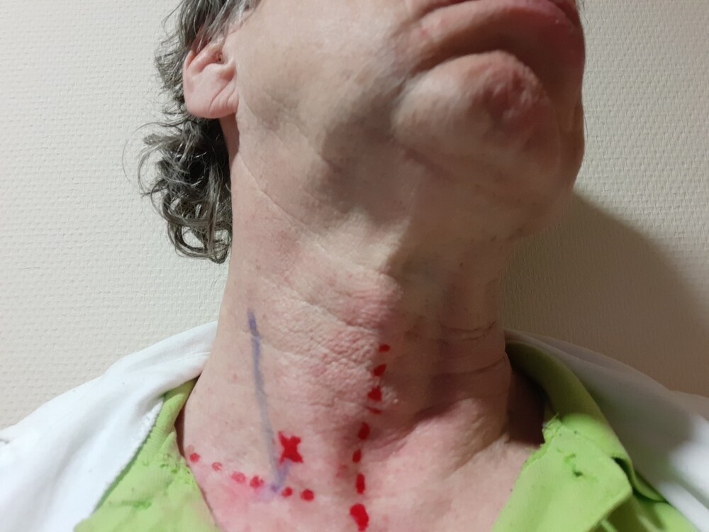 A nyak pozíciója ahhoz, hogy a boncleletben rögzített sérülések keletkezzenek (ép nyaki ütőér, sérült gyüjtőér, a nyakcsigolyába ékelődött lövedék). Az egyes képletek viszonyát nyaki ultrahanggal ellenőriztük. Kereszt jelzi a bemeneti nyílást. A nyaki gyűjtőeret (vena jugularis) kék vonal mutatja